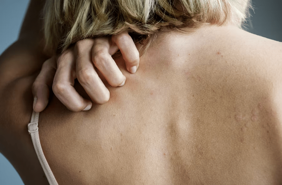 A Woman Suffering From Itchy Patches