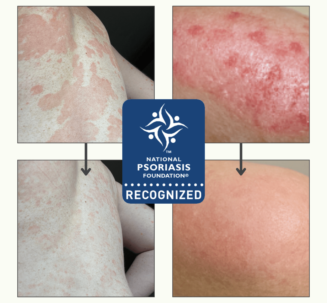 Supplements That Help Psoriasis-Prone Skin From the Inside Out