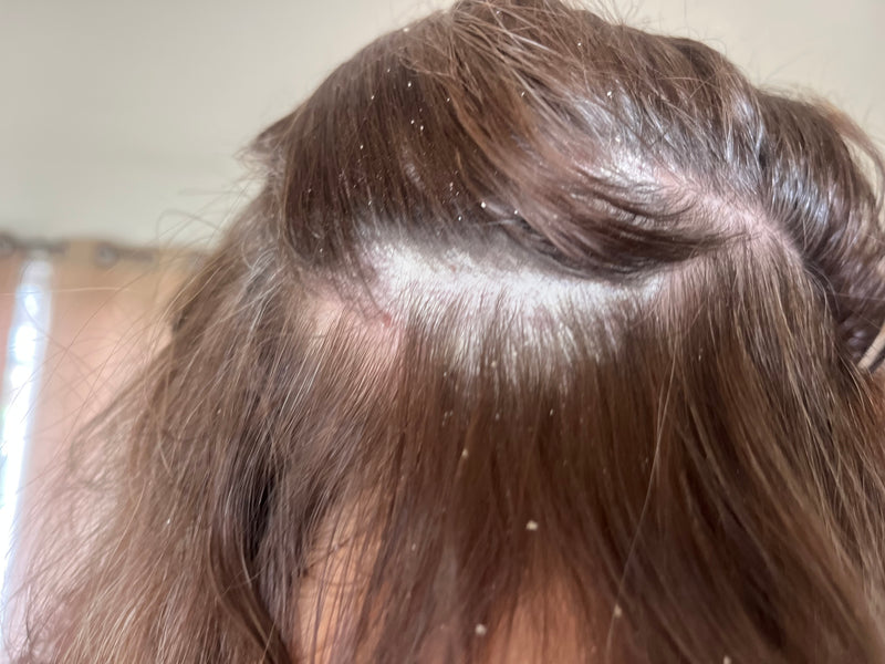 Close-up of a person's scalp and hairline showing dry white flakes and redness before using Broc Shot