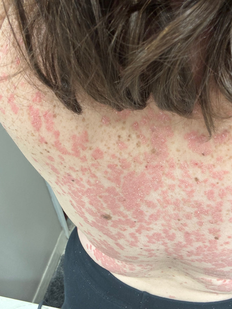 Upper back and shoulders with widespread red, scaly, raised psoriasis plaques and flaking skin