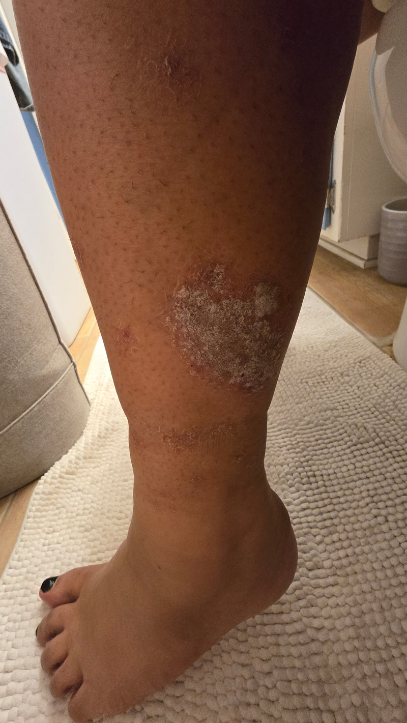 Lower right leg showing a large scaly psoriasis plaque above the ankle on a white bath mat