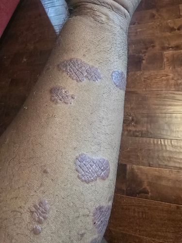 An arm with Psoriasis Plaques at week 1 of using broc shot