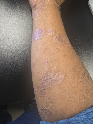 An arm with reduced Psoriasis plaques at week 4 of using broc Shot