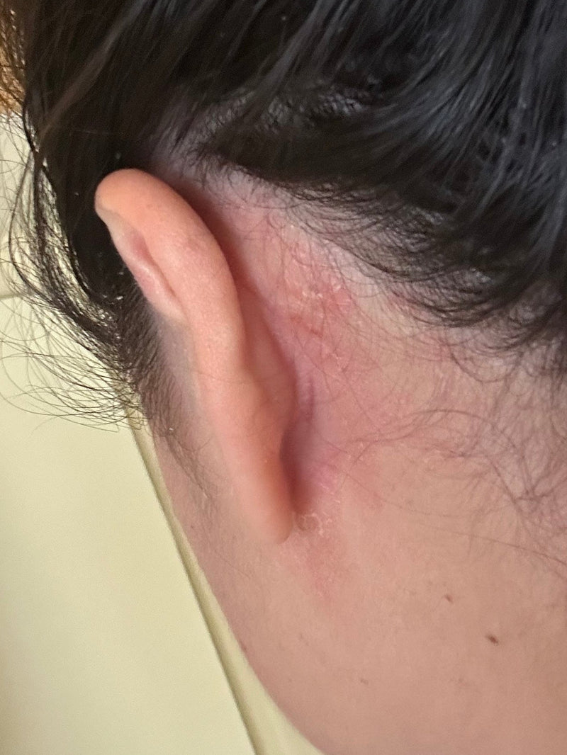 Close-up of a person's ear and nearby cheek showing red, flaky, peeling skin behind the ear against a neutral background