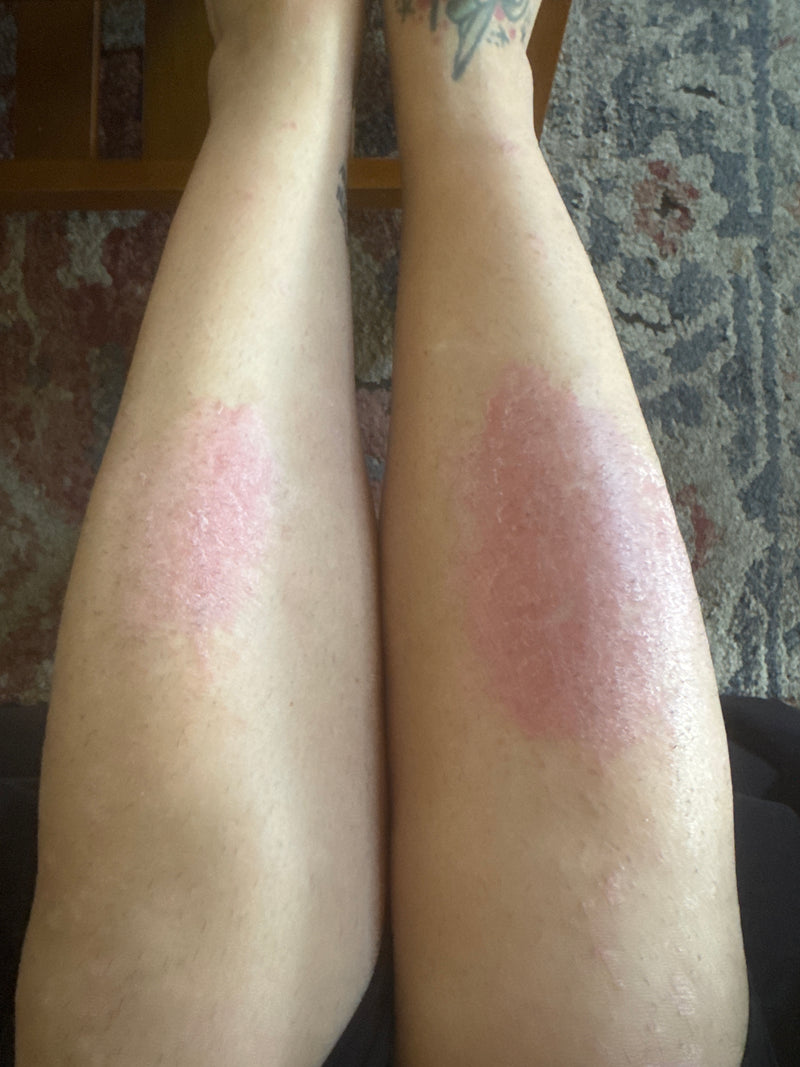 Lower legs showing red, scaly psoriasis patches, larger patch on the right calf against a patterned rug background