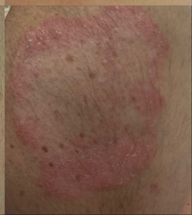 Close-up of red, scaly psoriasis plaque on hair-covered skin, part of a before-and-after patient photo series