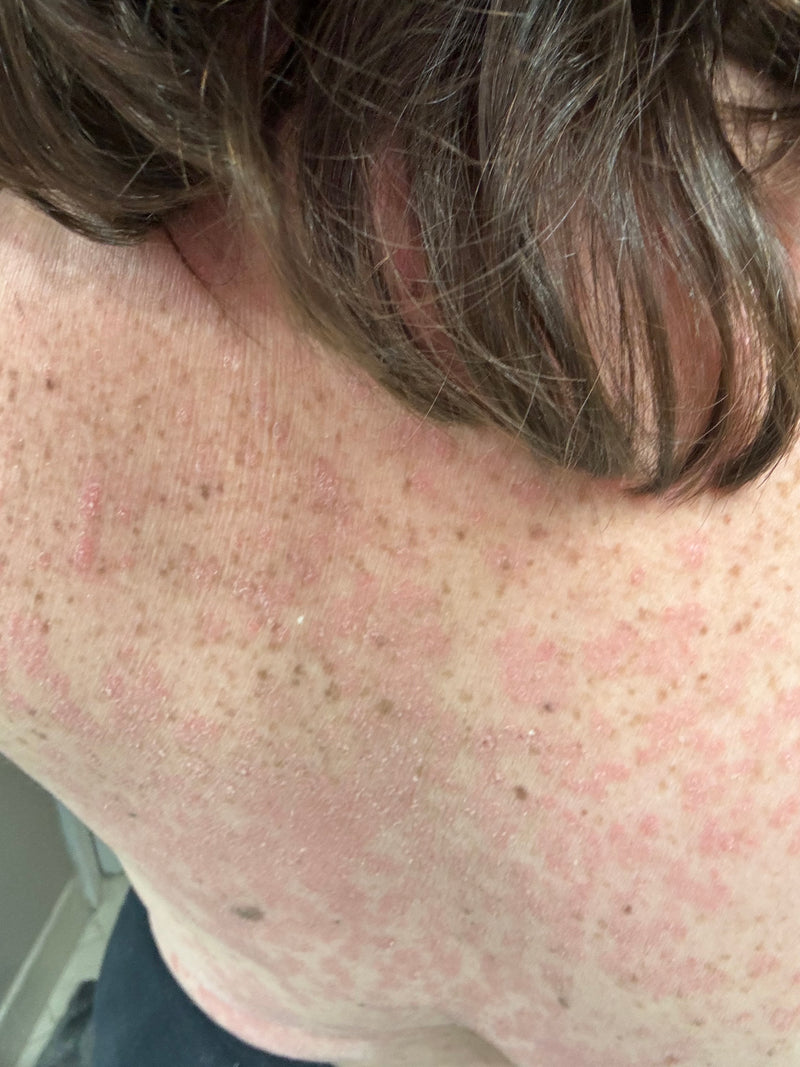 Close-up of neck and upper back skin showing red, scaly, patchy inflammation consistent with psoriasis