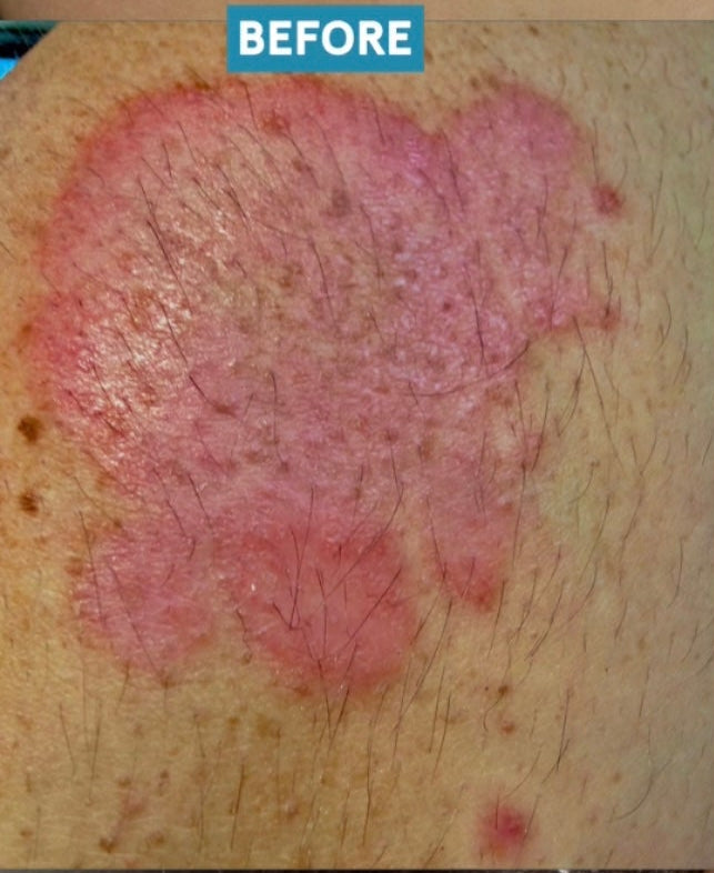 Close-up of red, scaly psoriasis plaque on a hairy forearm labeled BEFORE