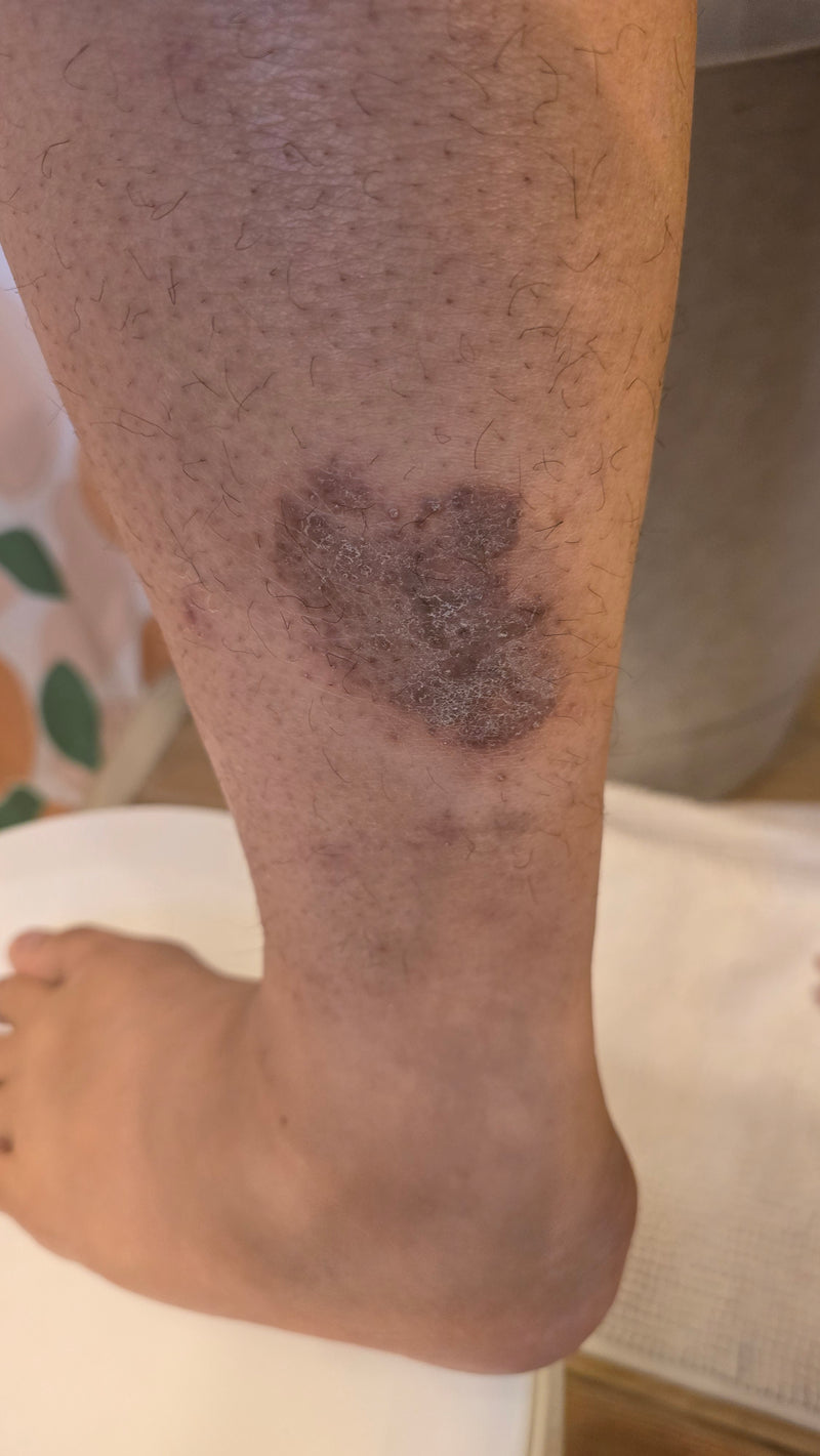 Close-up of lower leg showing a scaly, dark patch of psoriasis on the shin