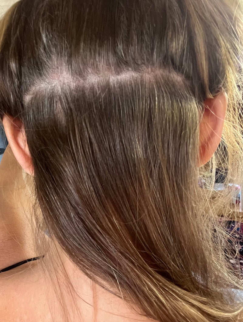 Close-up of the back of a person's head with brown hair parted to expose the scalp, shown as part of a before-and-after psoriasis comparison