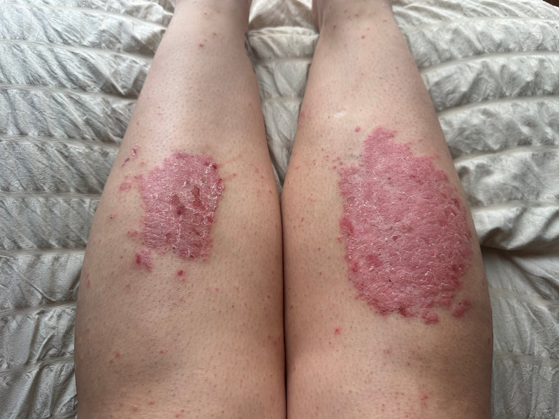 Lower legs showing large red, scaly psoriasis plaques on both shins before treatment