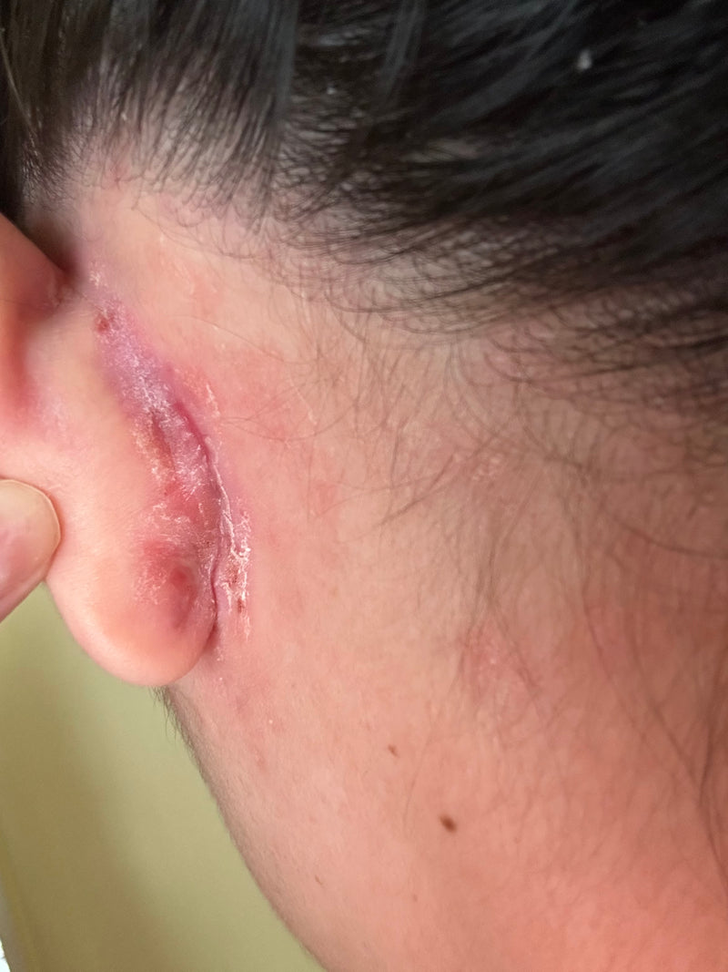 Close-up of left ear and temple showing inflamed red, scaly plaque with flaking on psoriasis-prone skin